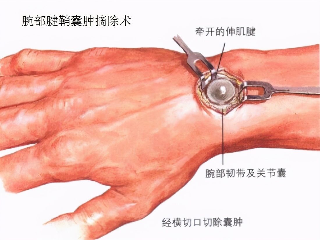 腕部腱鞘囊肿摘除术后康复