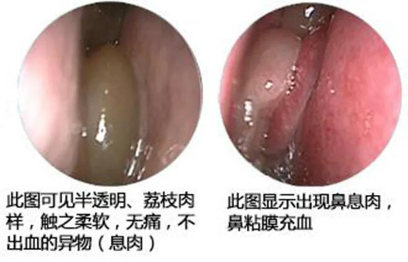老鼻炎怎么治,老人长期鼻炎需要注意什么