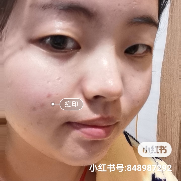 男士毛孔粗大出油痘坑痘印黑头,脸部出油有痘坑痘印毛孔粗大中医