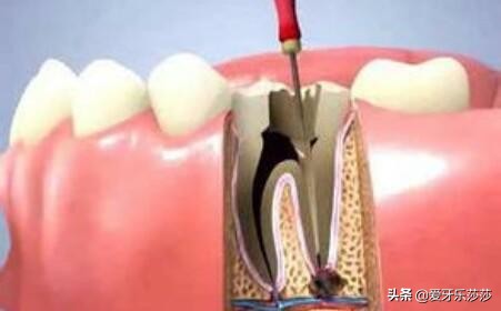 牙髓炎导致的牙齿神经疼，拔牙？根管治疗？究竟需要怎样治疗？