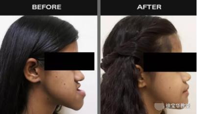 法令纹鼻基底填充玻尿酸方法,鼻基底底法令纹深怎么整