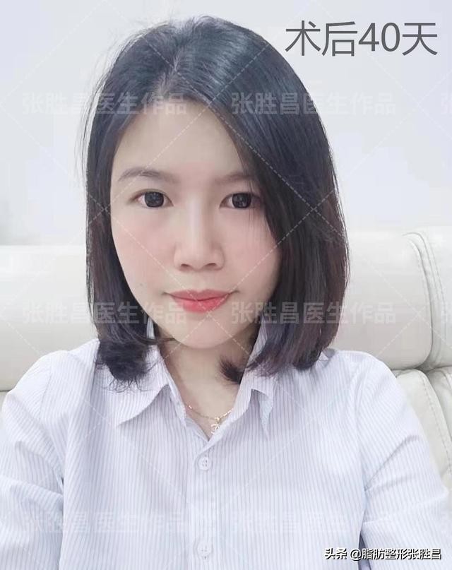 脂肪胶填充下巴法令纹,太阳穴和脸颊凹陷自体脂肪填充