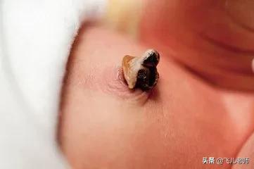 新生儿脐带发红怎么处理,新生儿脐带还没掉有臭味周围发红