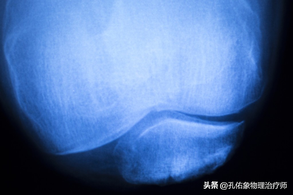 膝关节炎怎么解决疼痛,膝关节骨性关节炎最新的治疗方法