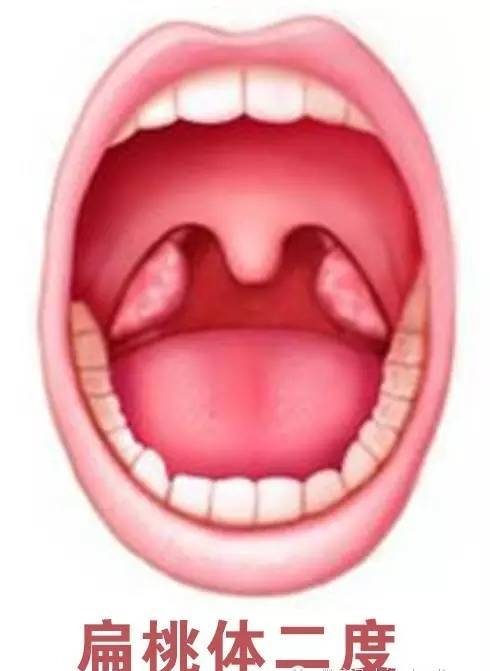 急性扁桃体炎引起的耳痛,急性扁桃体炎怎么缓解疼痛