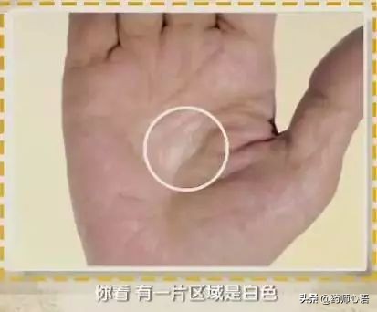 手上的健康秘密,手的颜色能看出健康的问题吗
