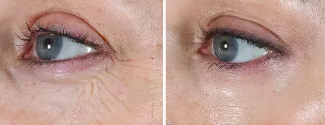 鱼尾纹法令纹抬头纹显老又难看,法令纹鱼尾纹抬头纹哪个最难看