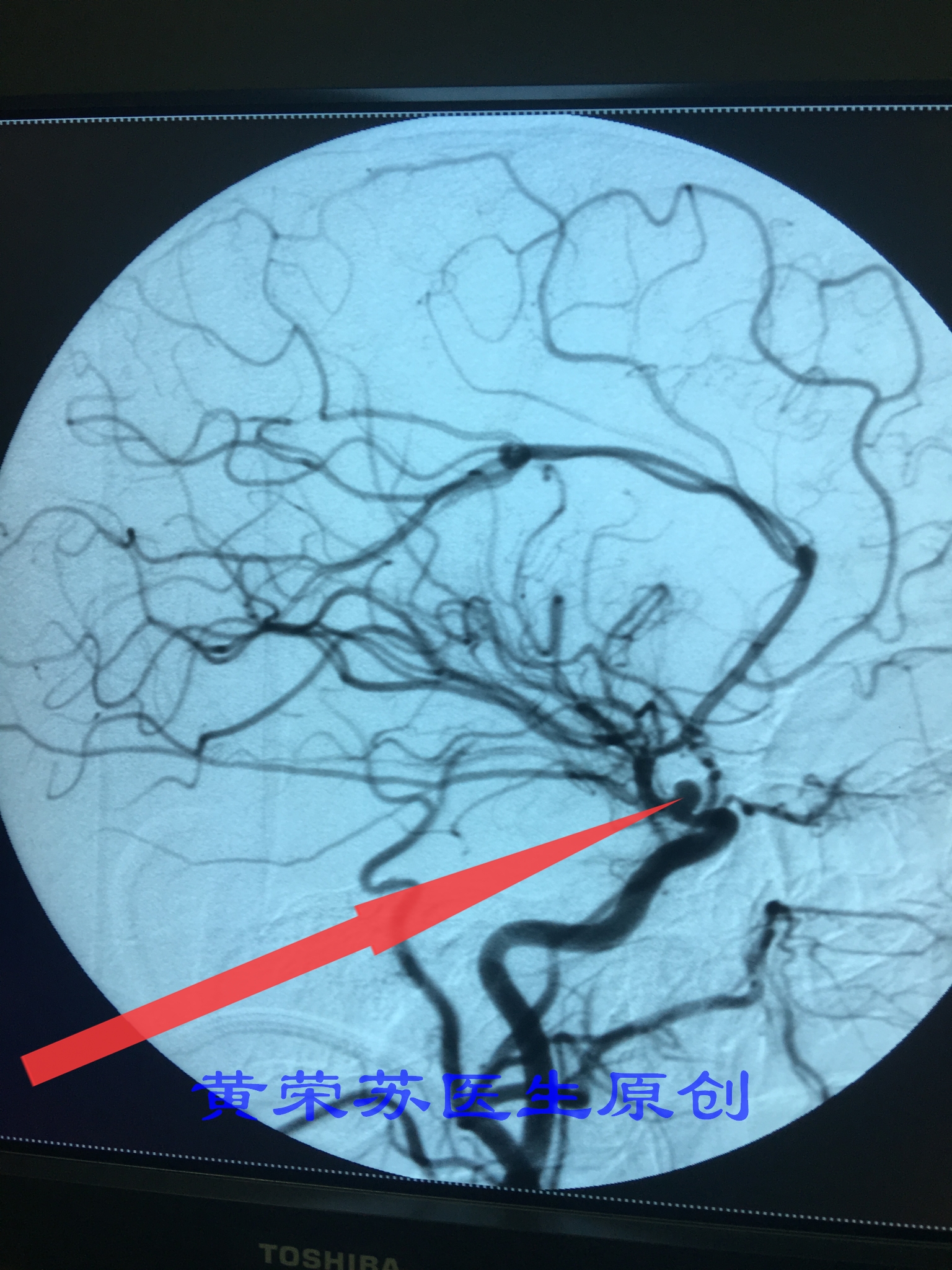 脑出血症状科普动画视频,脑出血的出血部位脑细胞会坏死吗