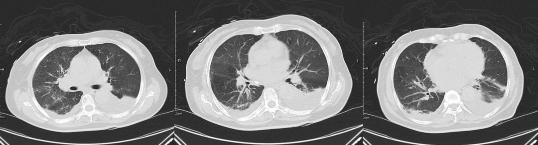 这例患者差点误诊为CAP，类似病变应如何逃离误诊「高发区」？