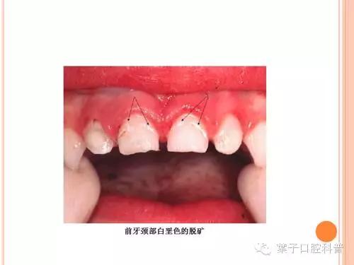 有牙洞用含氟牙膏,牙齿涂氟小知识