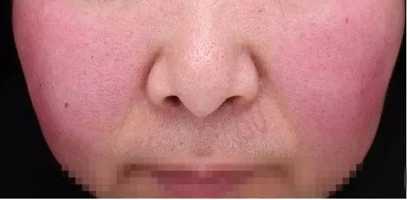 脸越洗越干净怎么回事,脸越洗毛孔越大