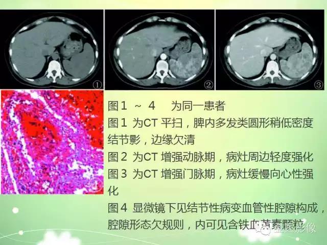 脾血管瘤中医辨证,脾血管瘤超声表现