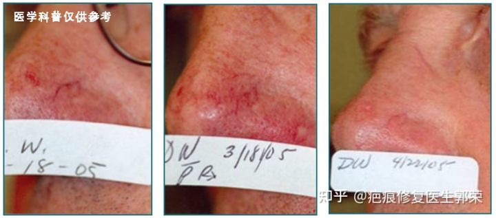 cynergy激光治疗仪副作用,cynergy双波长血管激光