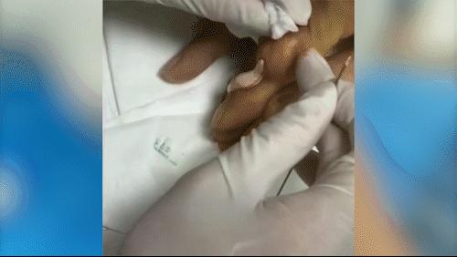 快速降尿酸治痛风的处方,痛风降尿酸中药靠谱吗