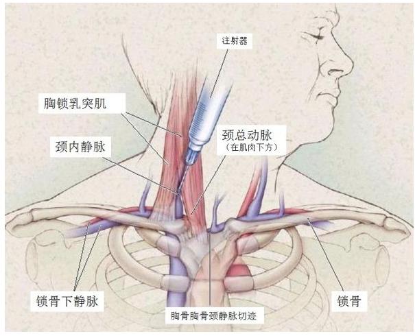 颈内静脉穿刺术禁忌,颈内静脉穿刺术教学视频