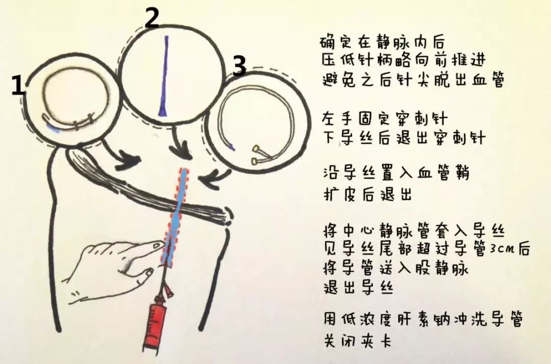 股静脉穿刺置管输液,股静脉穿刺置管术详细讲解