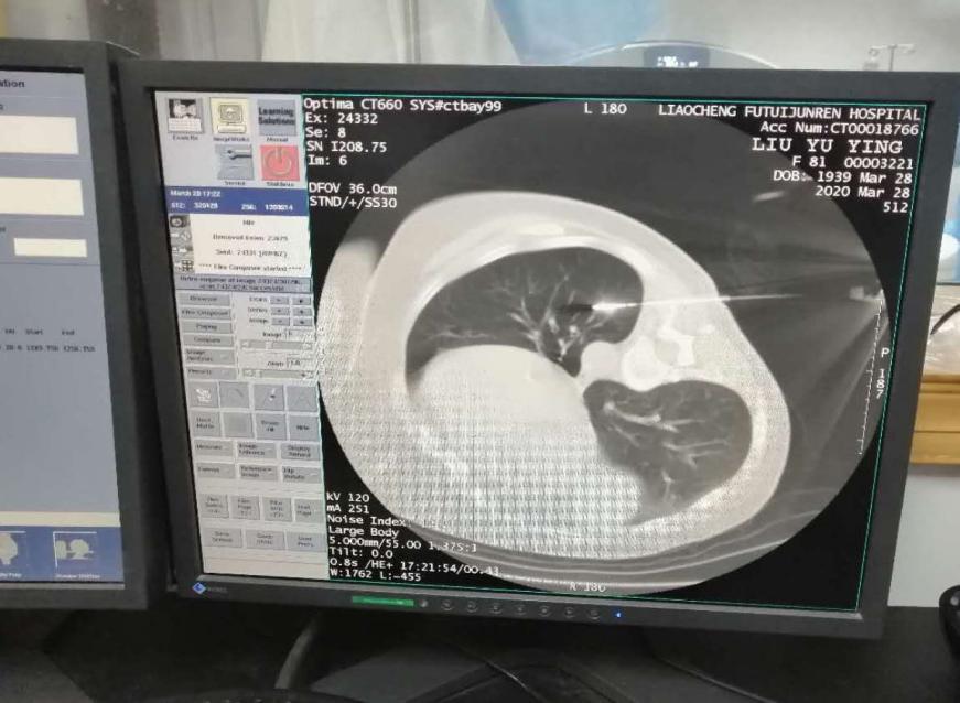 聊城退役军人医院能做手术吗,聊城市人民医院可以做射频消融术