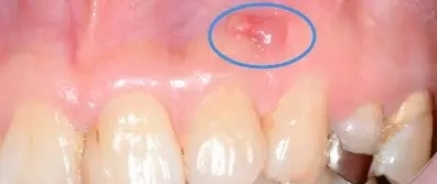 牙龈长脓包挤破又长回来,牙龈长脓包弄破了第二天又有脓