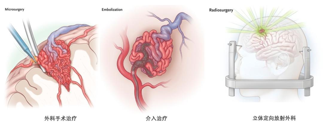 儿童脑血管畸形保守治疗方法,脑血管畸形加动脉瘤保守治疗