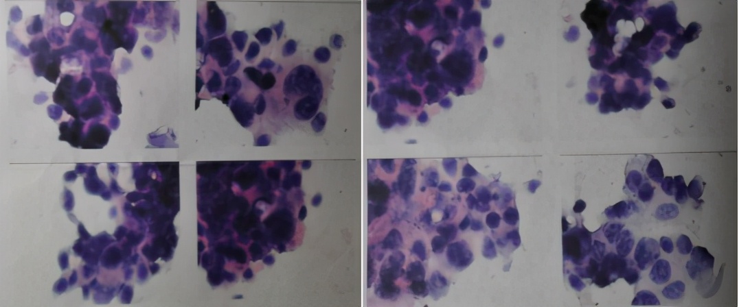 无明显诱因咳嗽、呼吸困难，大量胸腔积液，竟与妇科肿瘤有关？