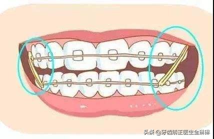 牙齿不整齐导致蛀牙推荐矫正吗,有蛀牙和空牙可以先矫正吗