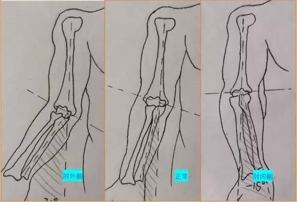 人的胳膊肘都是往里拐的,胳膊肘往里拐是什么原因
