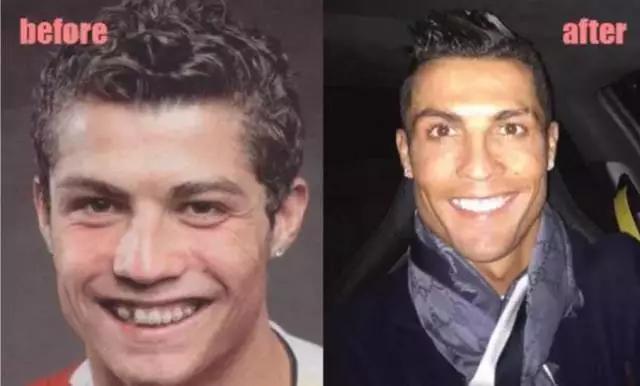 矫正牙齿可以改变小下颌吗,矫正牙齿可以改变脸型