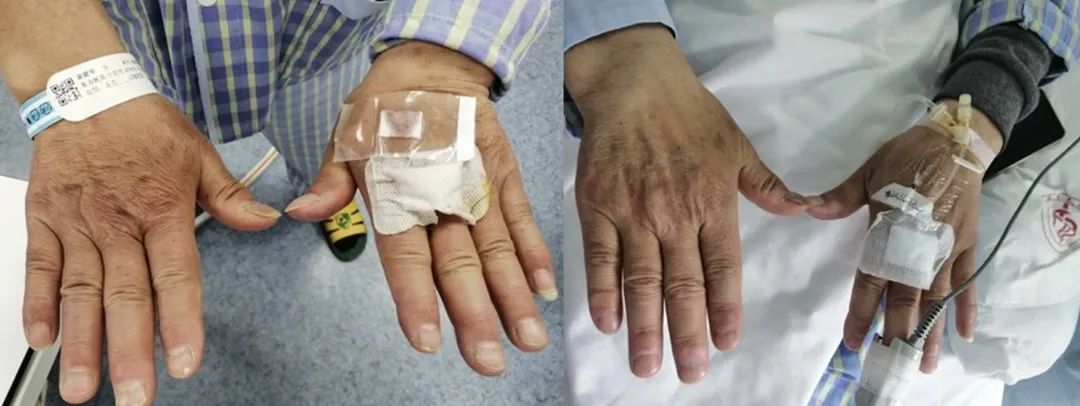 抗合成酶综合征是肺纤维化吗,抗合成酶综合征体征