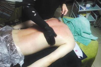 权健做火疗,权健火疗技术