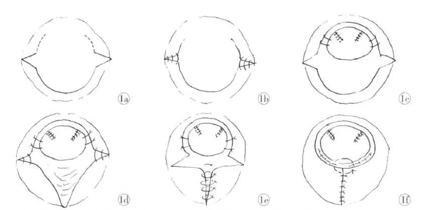 再造处女:处女膜修复术的是与非