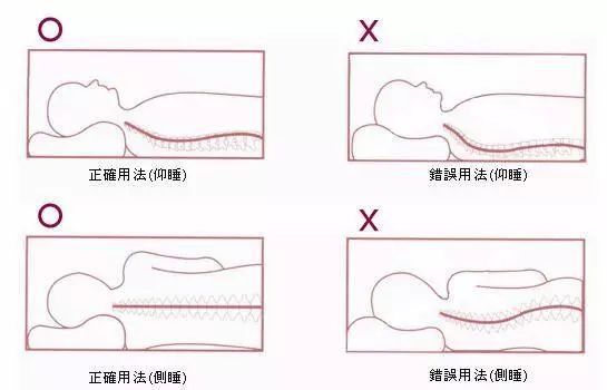 脖子落枕了怎么办最快最好的方法,落枕治疗最强攻略让脖子自由飞翔