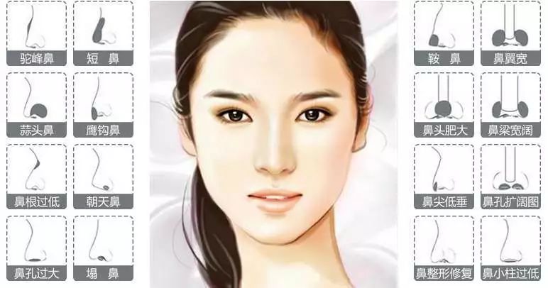 隆鼻选择哪种比较好,这些隆鼻的安全常识你需要知道