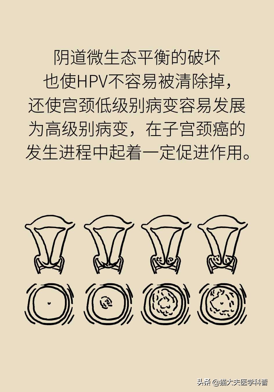 阴道炎会导致宫颈癌吗？