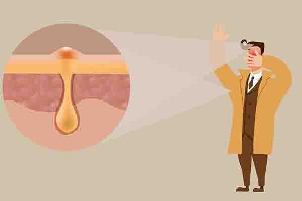 脂溢性脱发解决头皮出油方法,头发爱出油头皮有小红疙瘩脱发