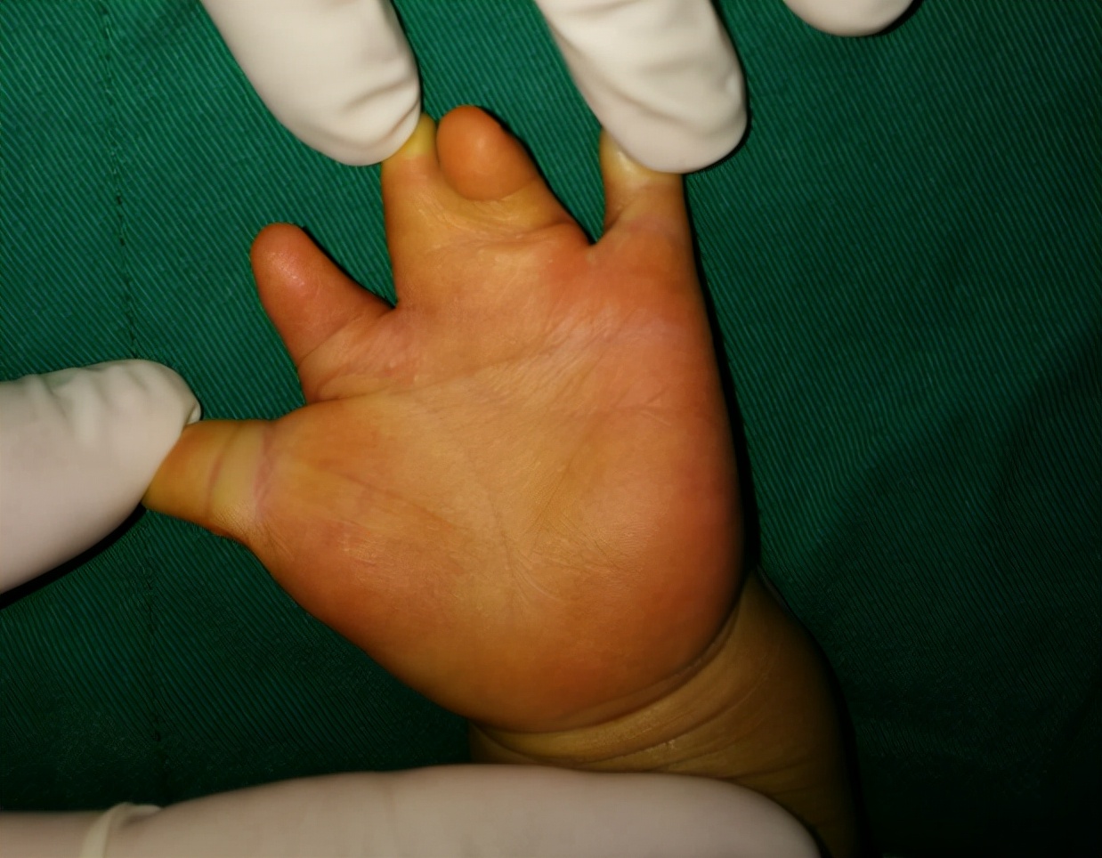 并指畸形免植皮案例,并指畸形