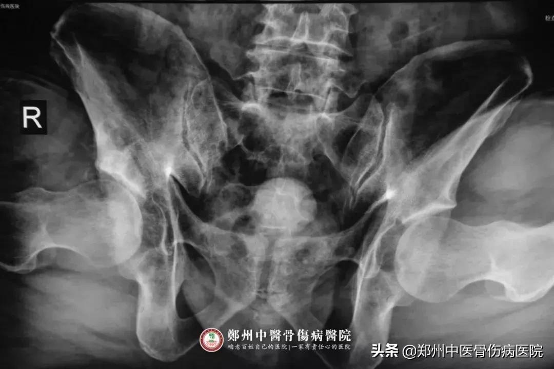 股骨头坏死钻孔减压后的康复视频,早期股骨头坏死用什么药最有效