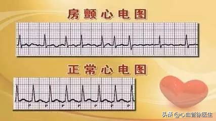 20岁女孩突发房颤伴脑梗，医生:这样做，房颤早发现，减少脑梗