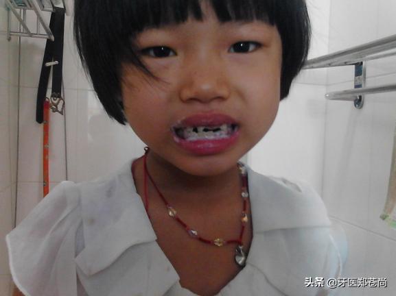 小孩没换牙有了蛀牙疼痛怎么办,小孩蛀牙疼痛怎么办止痛
