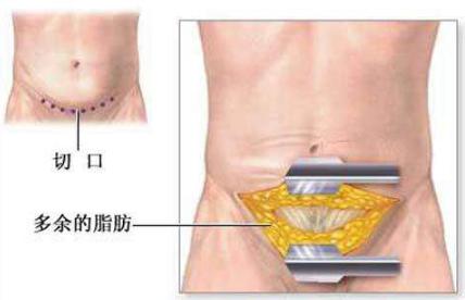 腹壁整形方法是什么呢图片,腹壁整形多久能大幅度运动