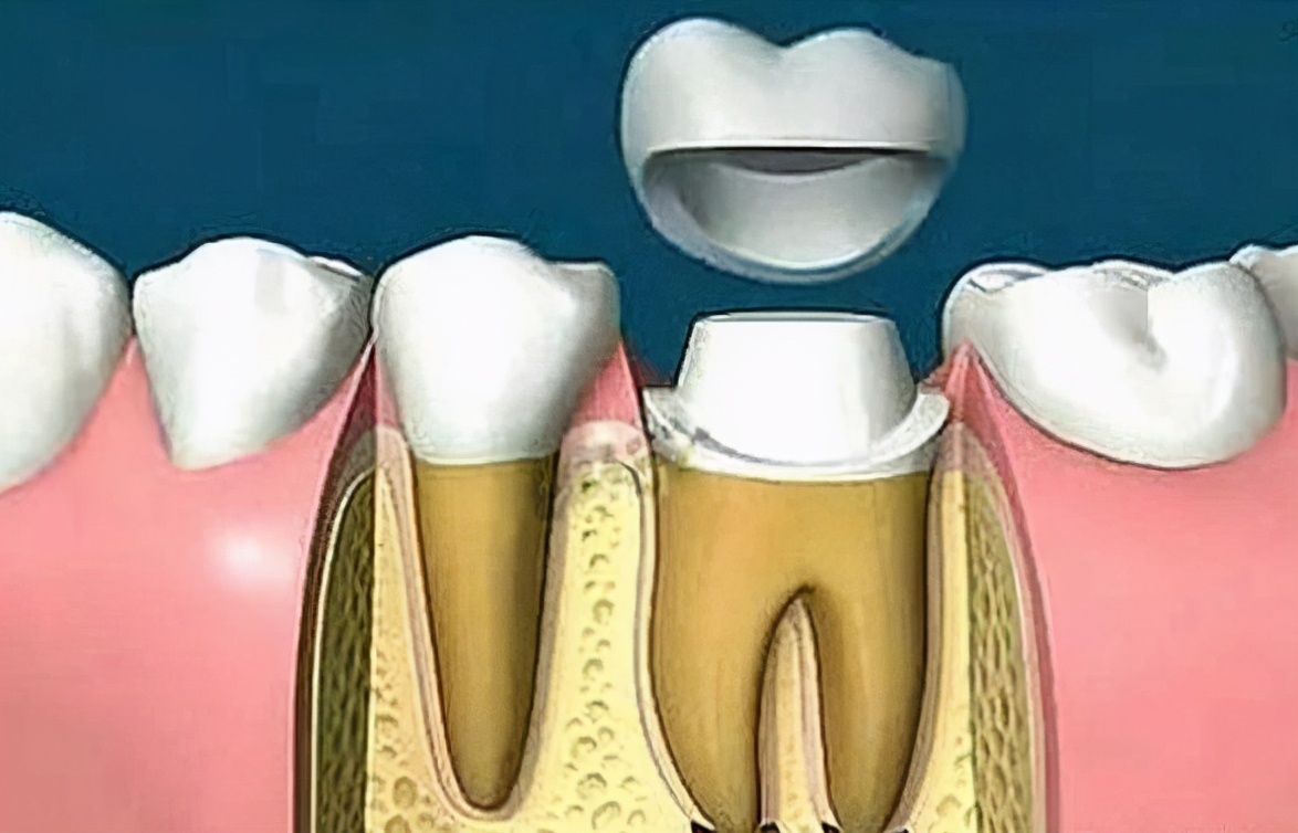 科普关于牙冠修复的三个常见问题,牙冠修复步骤详细介绍与解答