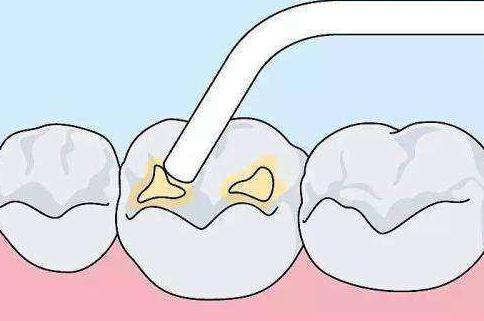 补牙后牙不舒服是正常现象吗,根管治疗补牙后牙齿酸痛正常吗