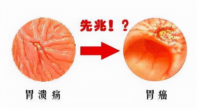 胃溃疡导致的后果有多严重,胃溃疡会造成什么后果