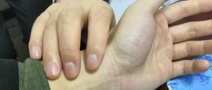 前列腺肥大并钙化吃什么中药合适,前列腺钙化是什么意思吃什么药