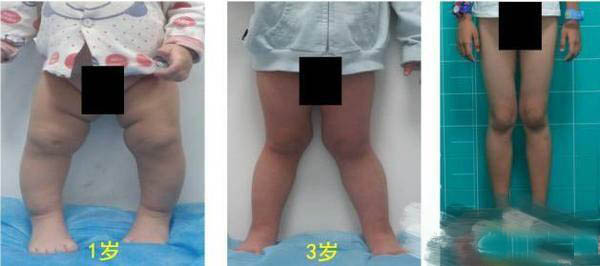 孩子的腿不直怎么办,为什么孩子腿不伸直