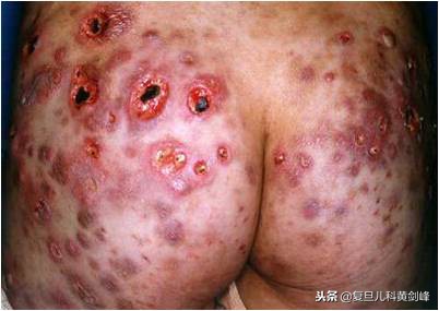 孩子腿上都是湿疹,宝宝腿上大面积皮疹