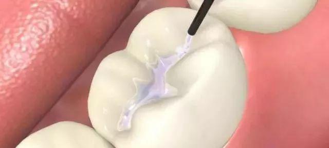 12岁牙齿有黑线怎么办自己怎么治,牙齿有黑线怎么预防不发展成龋齿