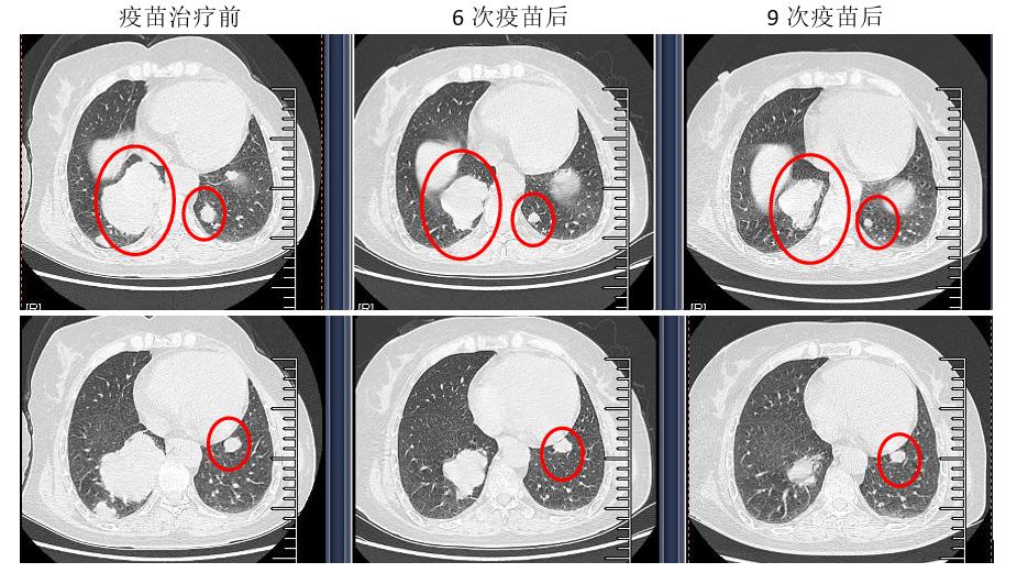 免疫治疗肾透明细胞癌有效吗,肾透明细胞癌肺转移靶向药