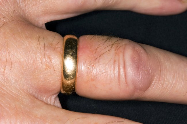 手指肿胀要警惕三种病,手指肿胀是10种疾病的警示信号