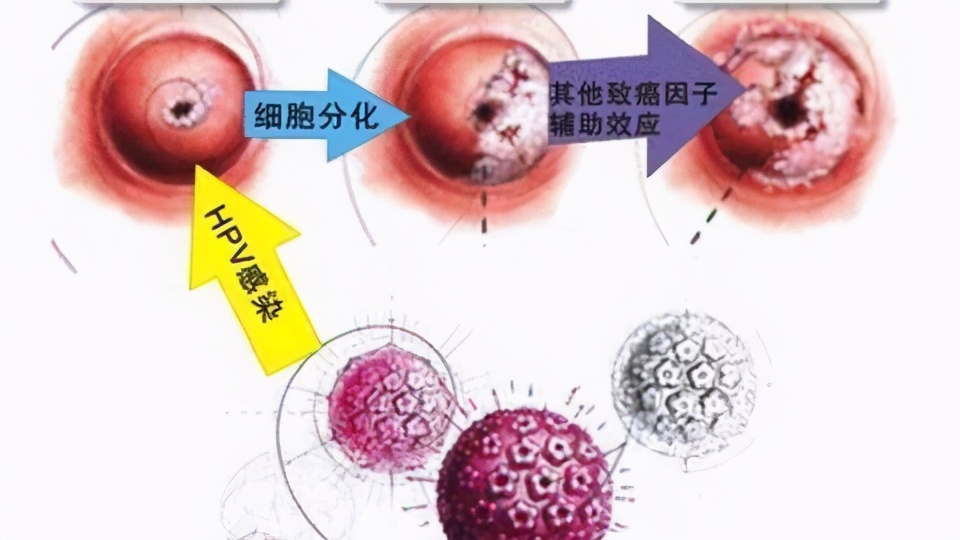 感染hpv病毒多久会形成宫颈癌,hpv病毒可以打宫颈癌疫苗防御么