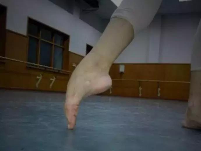 舞蹈哪些动作会导致脊椎损伤,舞蹈动作训练会造成身体损伤吗